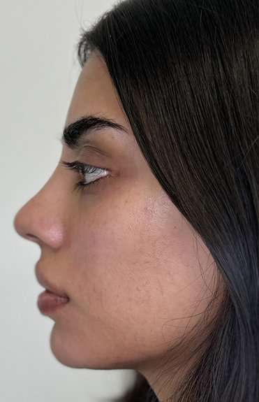 Full Facial Balancing Before & After Patient #901
