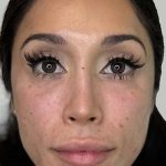 Full Facial Balancing Before & After Patient #904