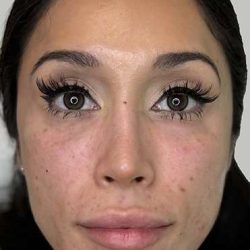 Full Facial Balancing Before & After Patient #904