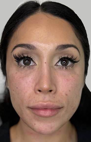 Full Facial Balancing Before & After Patient #904
