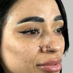Full Facial Balancing Before & After Patient #907