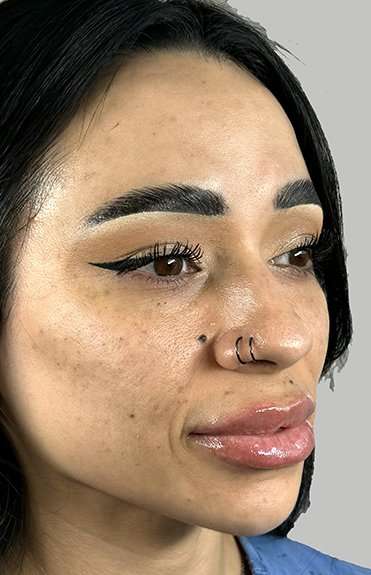Full Facial Balancing Before & After Patient #907