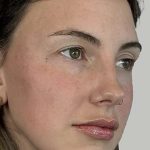 Full Facial Balancing Before & After Patient #914