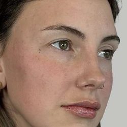 Full Facial Balancing Before & After Patient #914