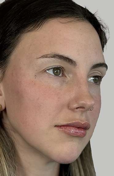 Full Facial Balancing Before & After Patient #914
