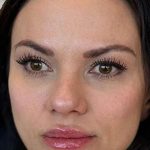 Full Facial Balancing Before & After Patient #919