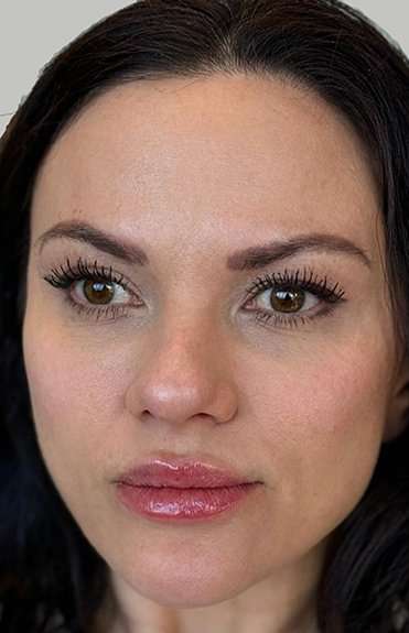 Full Facial Balancing Before & After Patient #919