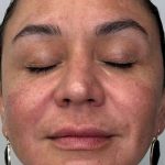Full Facial Balancing Before & After Patient #924