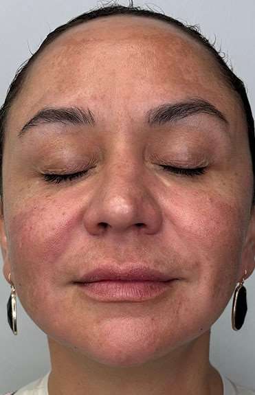 Full Facial Balancing Before & After Patient #924