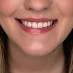 Botox/Dysport Before & After Patient #834