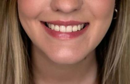 Botox/Dysport Before & After Patient #834