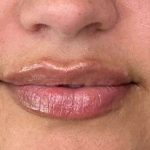 Lip Filler Before & After Patient #927