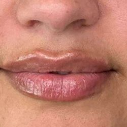 Lip Filler Before & After Patient #927