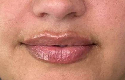 Lip Filler Before & After Patient #927