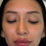 Lip Filler Before & After Patient #930