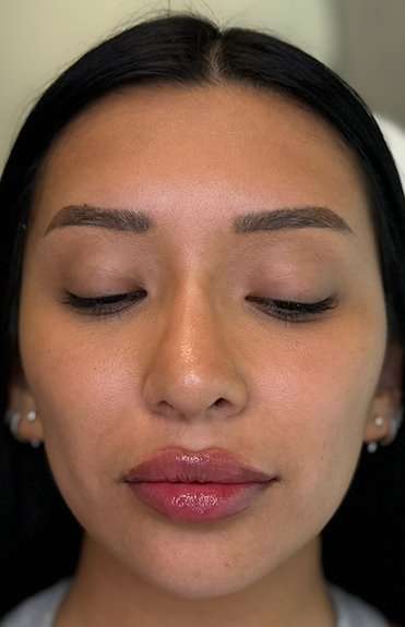 Lip Filler Before & After Patient #930
