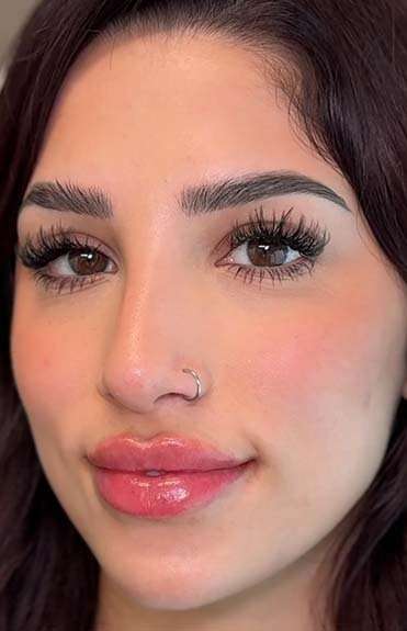 Lip Filler Before & After Patient #933