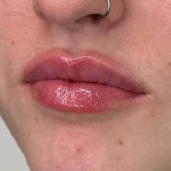 Lip Filler Before & After Patient #936