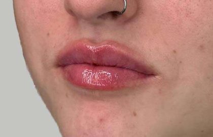 Lip Filler Before & After Patient #936