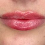 Lip Filler Before & After Patient #939