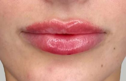Lip Filler Before & After Patient #939