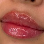Lip Filler Before & After Patient #942