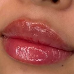 Lip Filler Before & After Patient #942