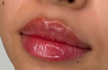Lip Filler Before & After Patient #942