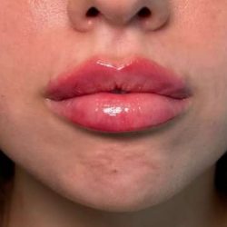 Lip Filler Before & After Patient #945