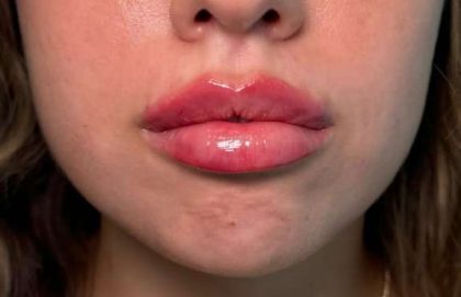 Lip Filler Before & After Patient #945