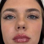 Lip Filler Before & After Patient #952