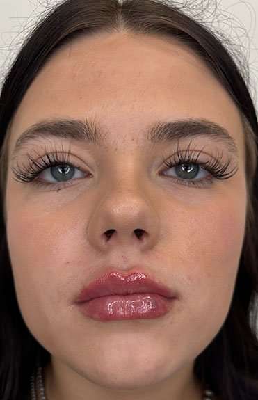 Lip Filler Before & After Patient #952