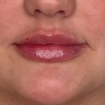 Lip Filler Before & After Patient #958