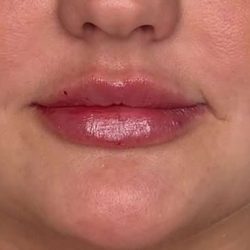Lip Filler Before & After Patient #958