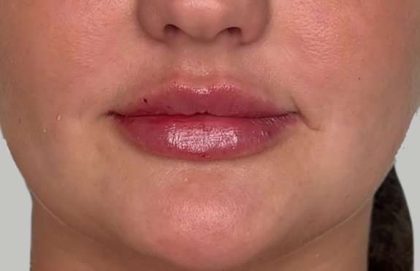 Lip Filler Before & After Patient #958