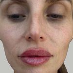 Lip Filler Before & After Patient #965