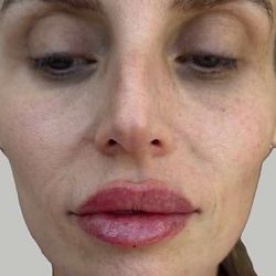Lip Filler Before & After Patient #965