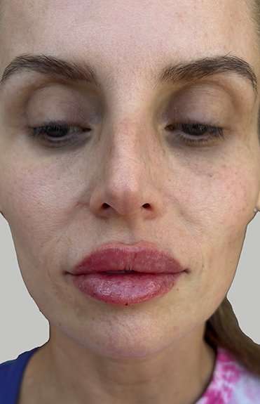 Lip Filler Before & After Patient #965
