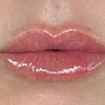 Lip Filler Before & After Patient #968