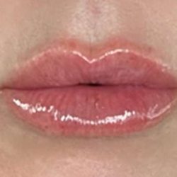 Lip Filler Before & After Patient #968