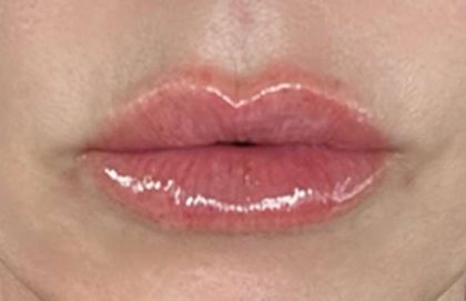 Lip Filler Before & After Patient #968