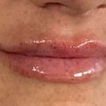 Lip Filler Before & After Patient #971