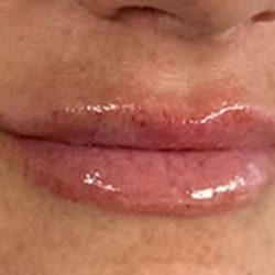 Lip Filler Before & After Patient #971