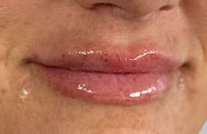 Lip Filler Before & After Patient #971