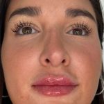 Lip Filler Before & After Patient #981