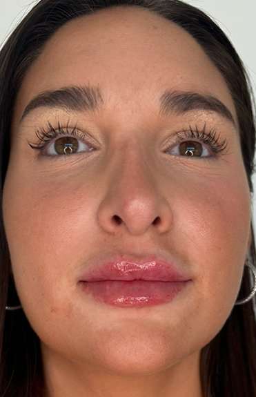 Lip Filler Before & After Patient #981