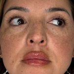 Lip Filler Before & After Patient #984
