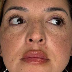 Lip Filler Before & After Patient #984