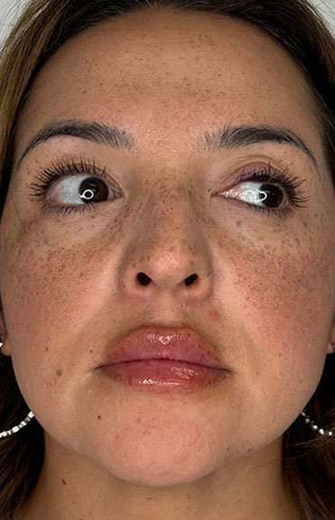Lip Filler Before & After Patient #984