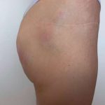 Non-Surgical BBLs Before & After Patient #987